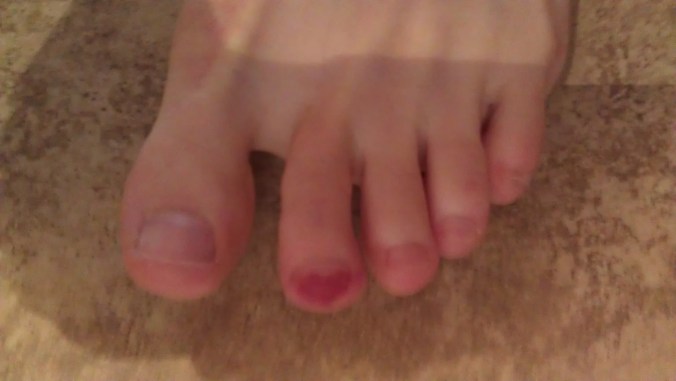 Awesome post-training blood blister.