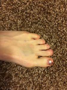 What it looks like when you stub your toe and drop a shampoo bottle on it all in one night